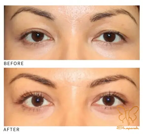 تفاوت پتوز و افتادگی پوست پلک