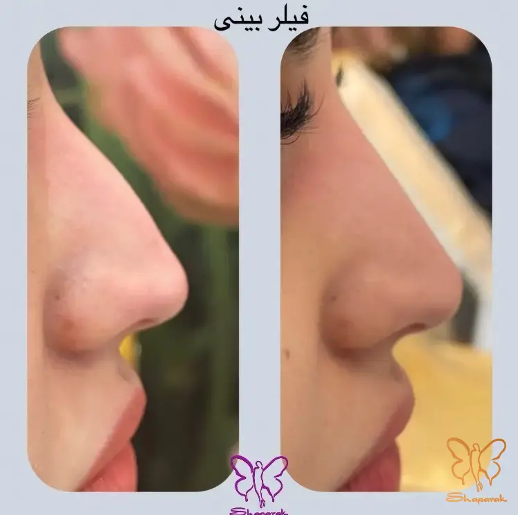 جراحی بینی در مشهد