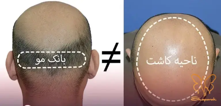 چالشها و واقعیتهای کاشت مو با بانک موی محدود