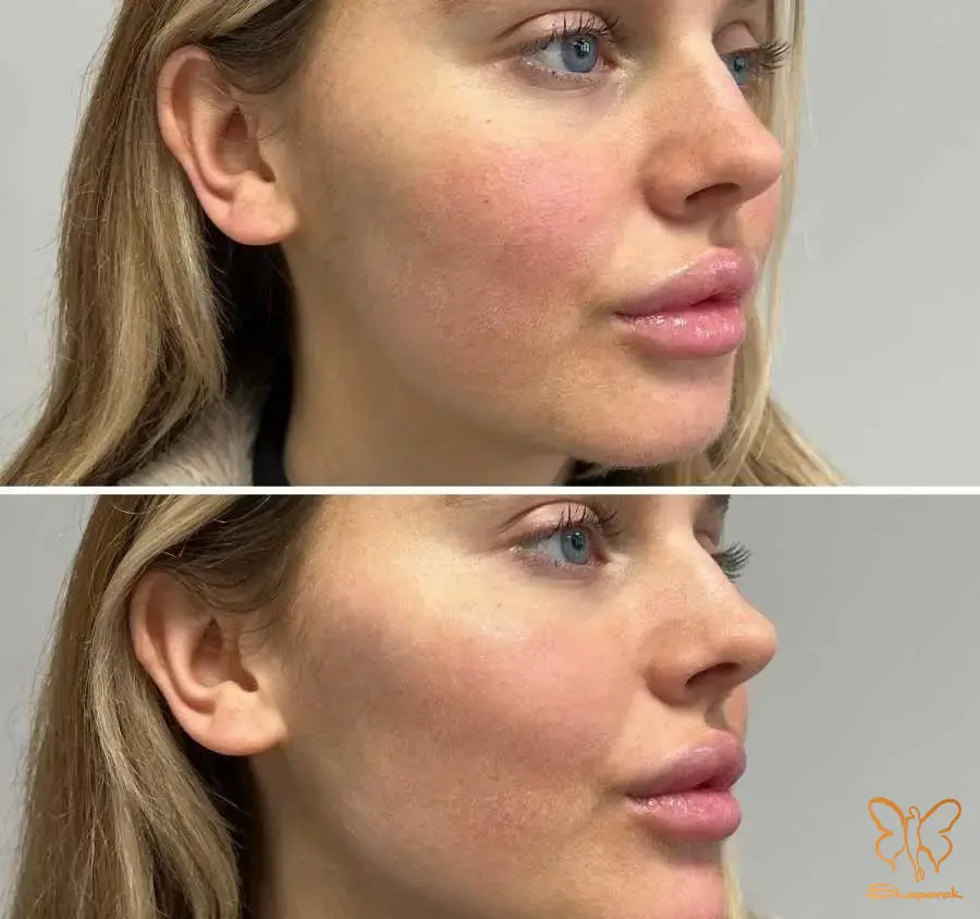 جوانسازی پوست جوانسازی پوست