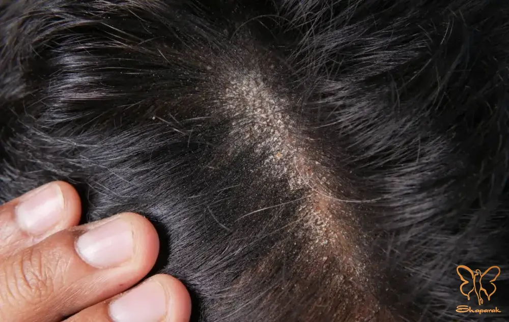 اوره و سلامت مو و پوست سر