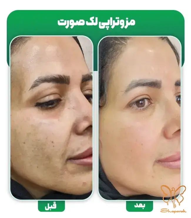 جوانسازی پوست جوانسازی پوست