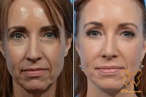 کلینیک تخصصی پوست و مو شاپرک طلایی مشهد