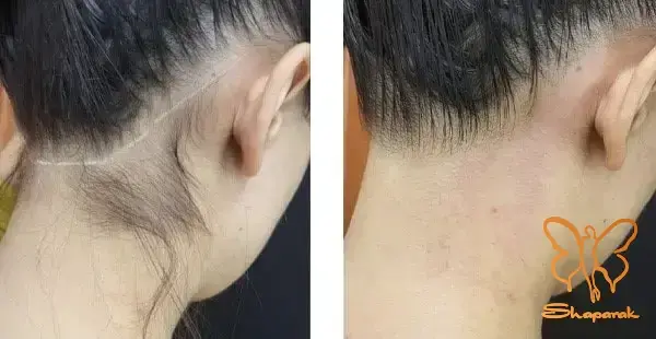 دستگاه رفع موهای زائد&nbsp;الکساندرایت موتوس مشهد