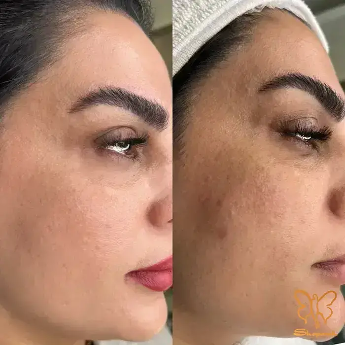&nbsp;کلاژن و الاستین سازی