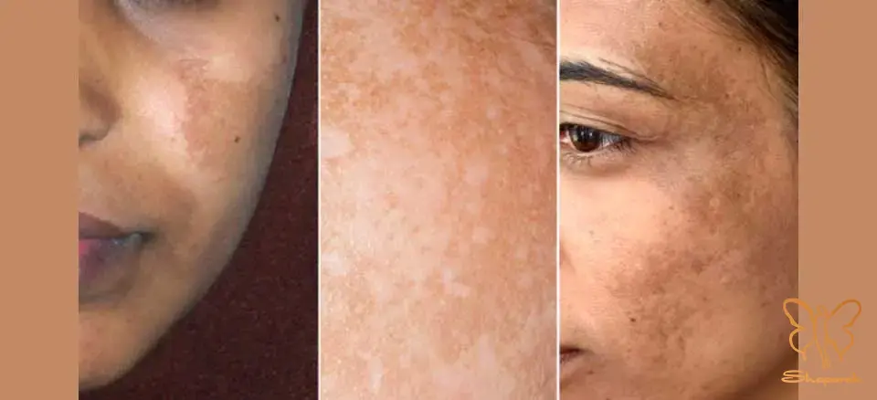 ملاسما Melasma