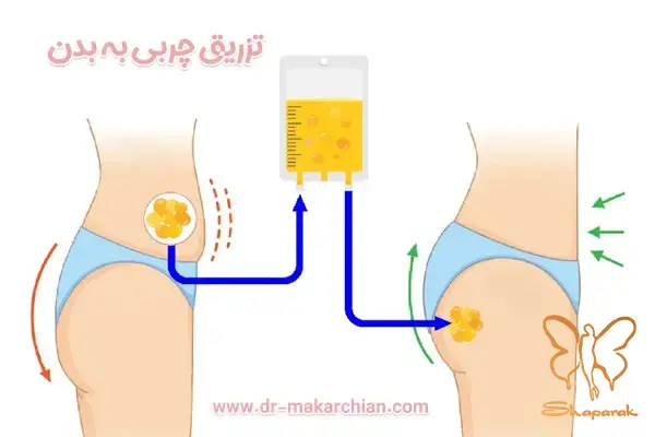 تزریق چربی به پشت دست در مشهد