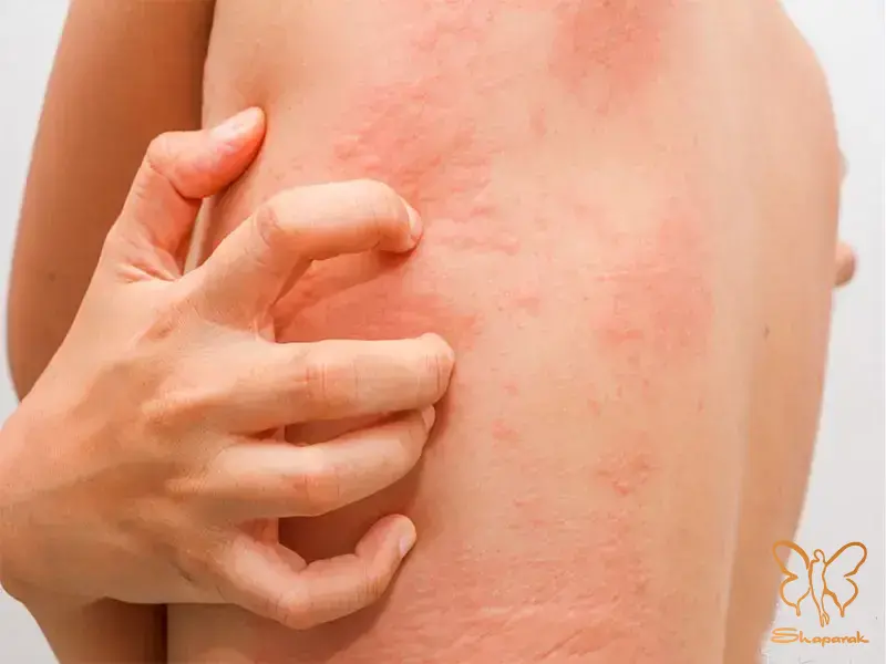 کهیر سرخی پوست و خارش بسیار در تمام بدن