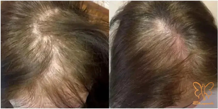 درمان ریزش مو با کربوکسیتراپی سر در کلینیک شاپرک طلایی مشهد درمان ریزش مو با کربوکسیتراپی سر در کلینیک شاپرک طلایی مشهد