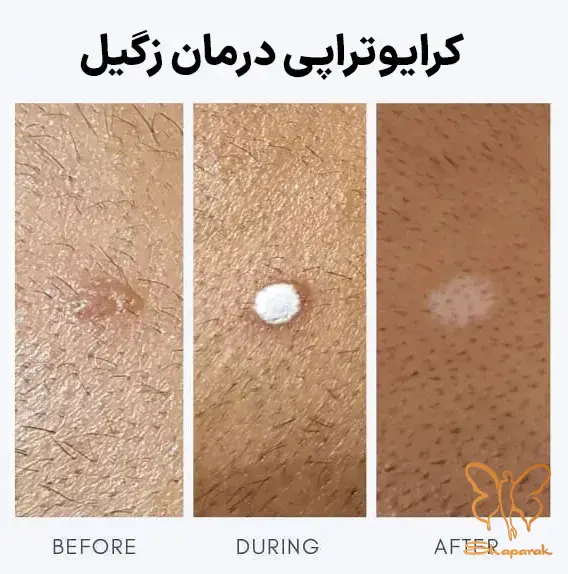 زگیل یا ضایعات پوستی زگیل یا ضایعات پوستی