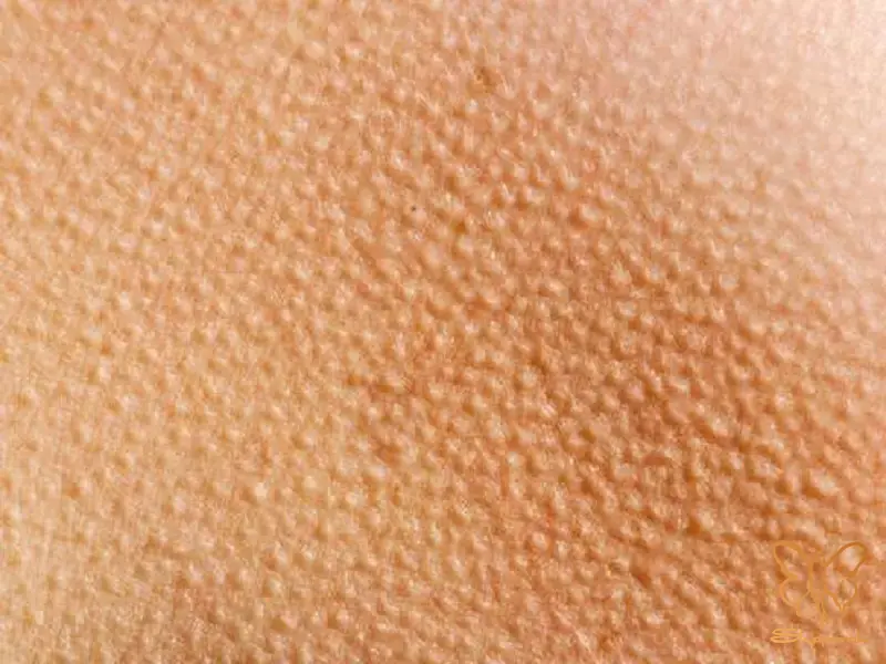 چرا به آن پوست مرغی میگویند