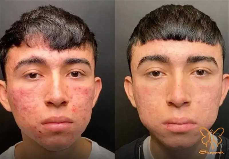 جوانسازی پوست جوانسازی پوست