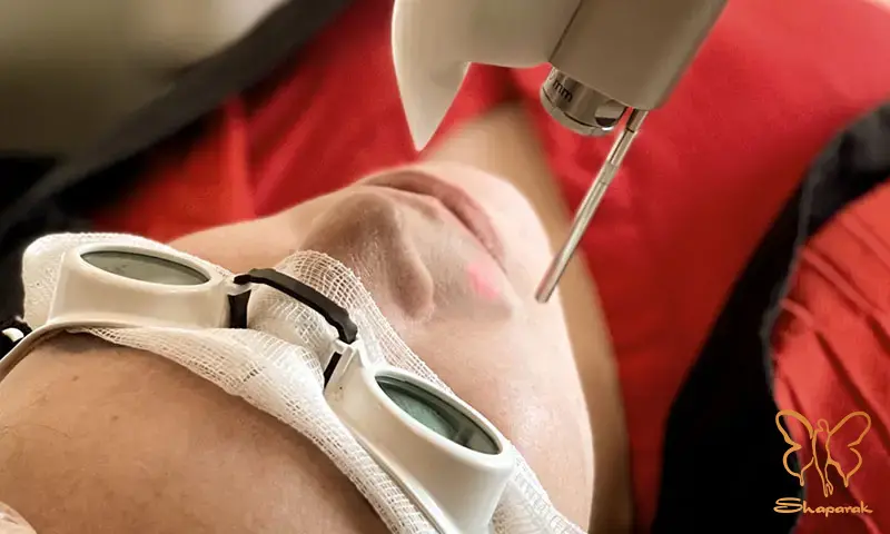 شرایط حیاتی در انجام لیزر فوتونا 4D برای جوانسازی پوست شرایط حیاتی در انجام لیزر فوتونا 4D برای جوانسازی پوست