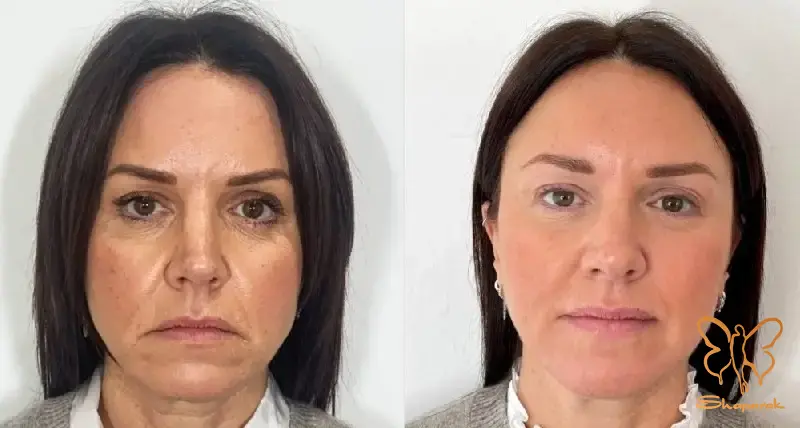 ژل یا فیلر پوستی