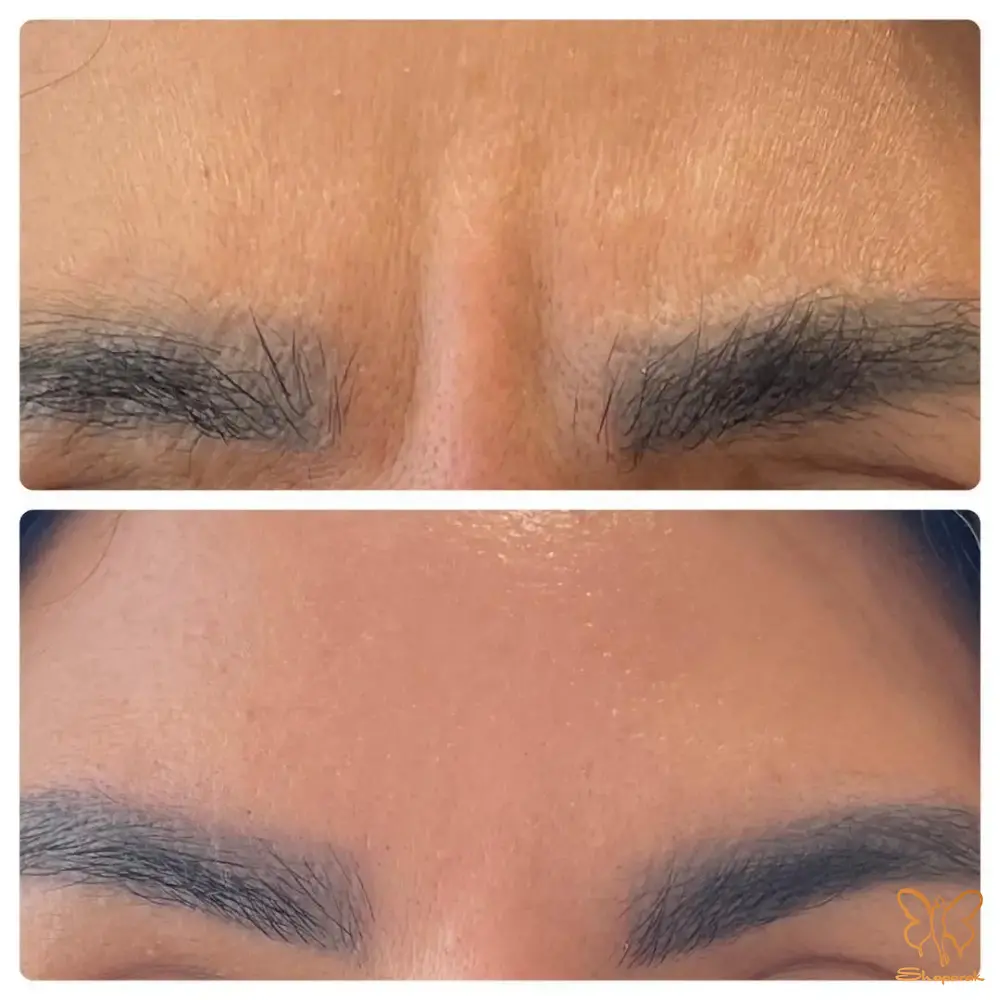 بوتاکس چگونه خط اخم را به طور طبیعی محو میکند