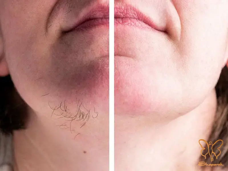 نواحی مقاوم به لیزر مو زائد در بدن نواحی مقاوم به لیزر مو زائد در بدن