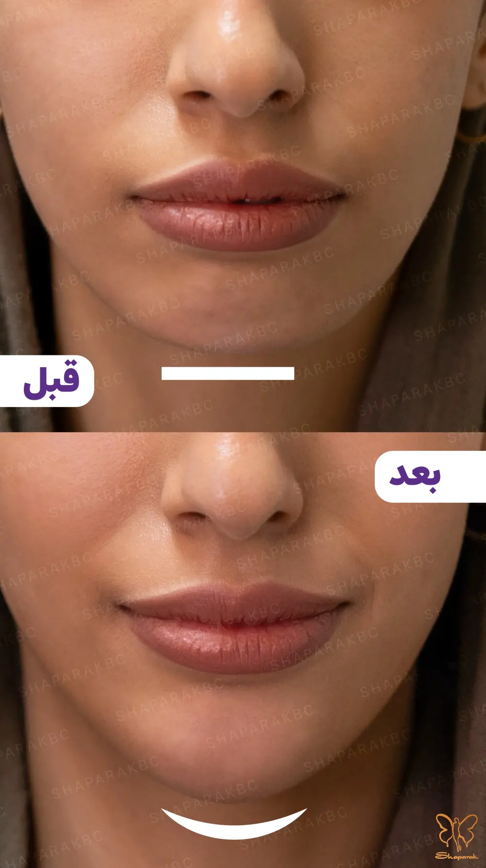 اسکالپچرا برای رفع چین و چروک عمیق صورت
