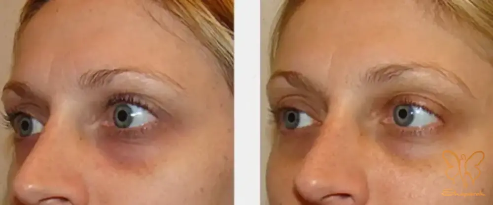 رفع تیرگی دور چشم رفع تیرگی دور چشم