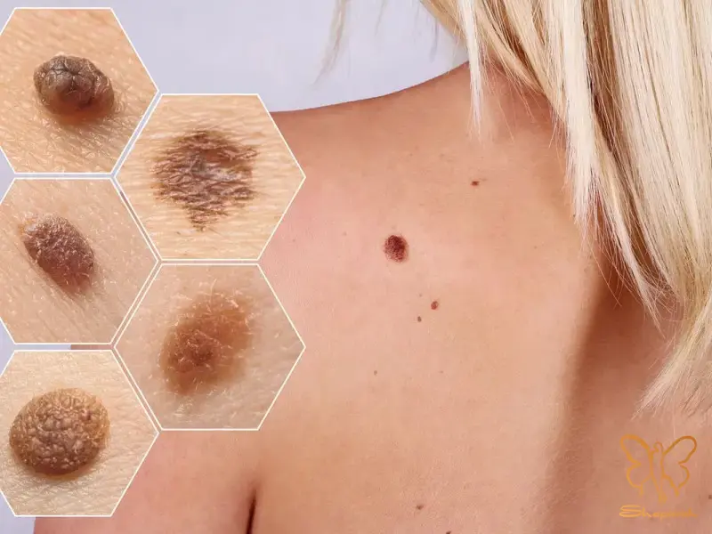 سرطان های مرتبط با ایدز مختل شدن عملکرد سلول های ایمنی سرطان های مرتبط با ایدز مختل شدن عملکرد سلول های ایمنی