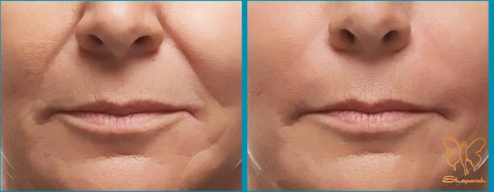 با تزریق فیلر خط خنده شادابی را به لبخندتان بازگردانید مشهد با تزریق فیلر خط خنده شادابی را به لبخندتان بازگردانید مشهد