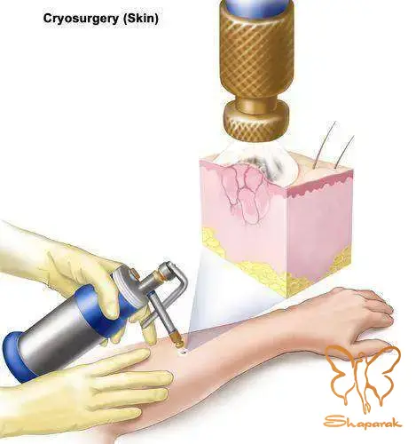 حذف خال با لیزر CO2 سریع بدون درد و بدون جای زخم