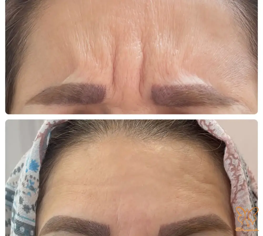 تزریق فیلر برای حجم دهی و جوانسازی صورت در مشهد