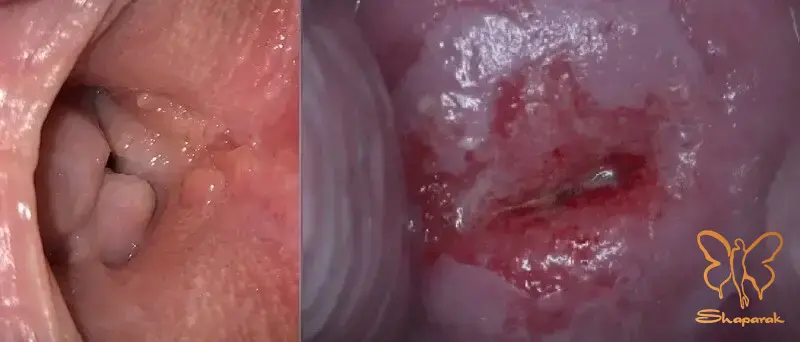 تفاوت تیپ های کم خطر و پرخطر Oncogenic HPV