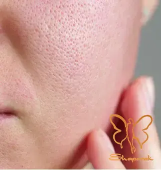 آیا سفیدآب واقعا منافذ پوست را باز می کند آیا سفیدآب واقعا منافذ پوست را باز می کند