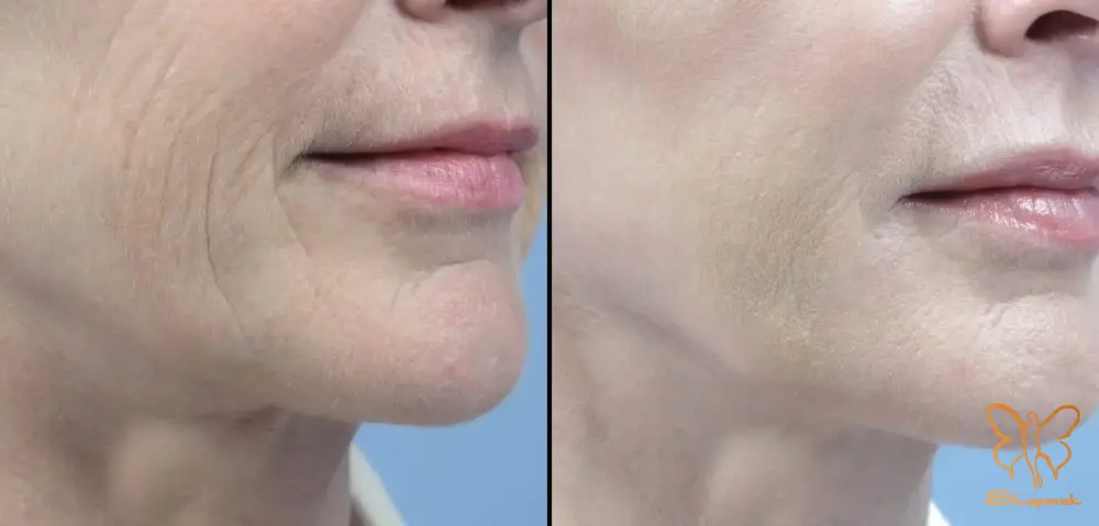 پروتکل درمانی RF و تاثیر مستقیم آن بر رفع خطوط صورت در مشهد پروتکل درمانی RF و تاثیر مستقیم آن بر رفع خطوط صورت در مشهد