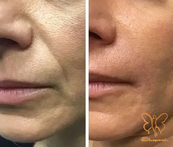 تفاوت کاربردی استایلج M و استایلج L در رفع خط خنده تفاوت کاربردی استایلج M و استایلج L در رفع خط خنده