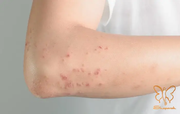 چرا سلامت پوست آینه سلامت کبد است