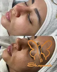 پاکسازی ایزودنس و ایزوفیشال در شاپرک مشهد پاکسازی ایزودنس و ایزوفیشال در شاپرک مشهد