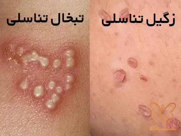 ویروس هرپس سیمپلکس HSV عامل تبخال