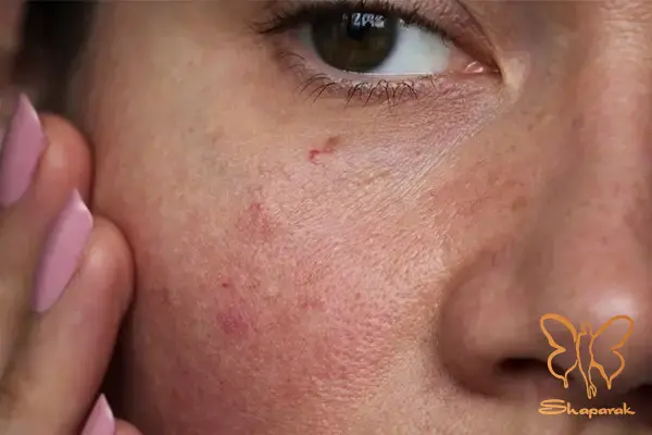 پیری زودرس پوست پیری زودرس پوست