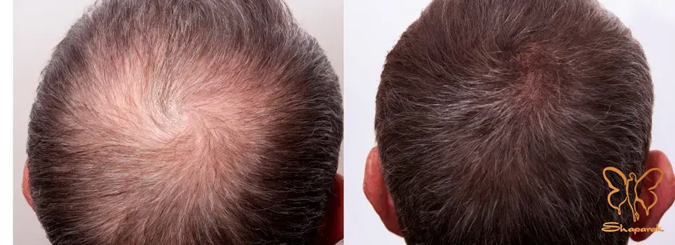 تحریک شدید کلاژن و الاستین سازی