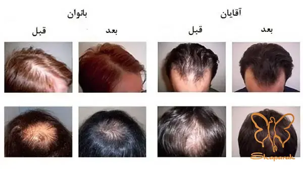 پلاسمای غنی از پلاکت خون پلاسمای غنی از پلاکت خون