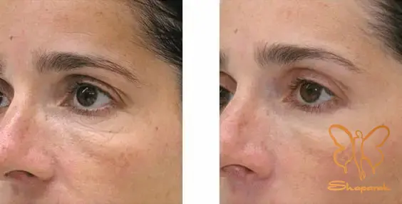 چه کسانی کاندیدای مناسب مزوتراپی ابرو هستند چه کسانی کاندیدای مناسب مزوتراپی ابرو هستند