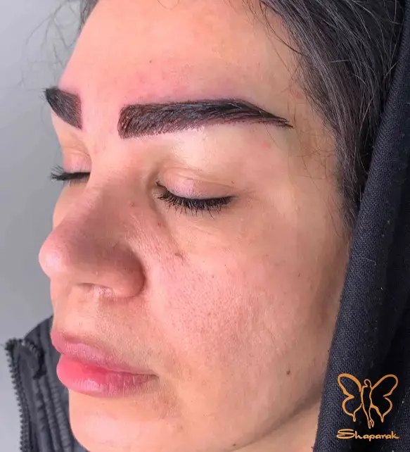 تعداد جلسات و فواصل زمانی درمان مزوتراپی و کاشت ابرو در مشهد تعداد جلسات و فواصل زمانی درمان مزوتراپی و کاشت ابرو در مشهد