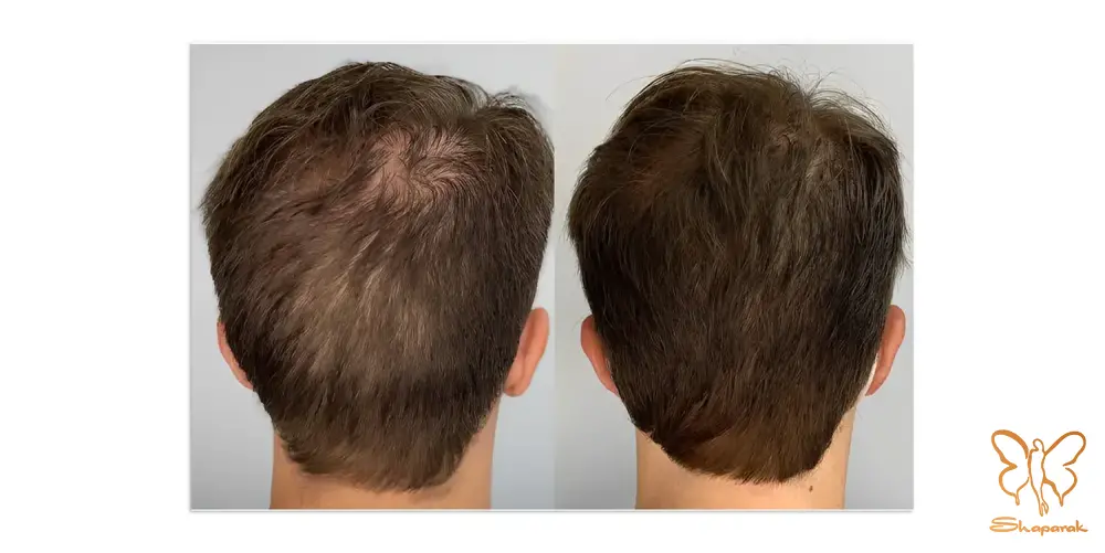 تاثیر پلوریال و رویتا بر کیفیت ساقه مو تاثیر پلوریال و رویتا بر کیفیت ساقه مو