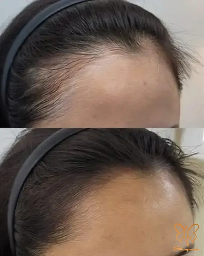 مدت زمان مصرف زینک سلنیوم و دوره درمان مدت زمان مصرف زینک سلنیوم و دوره درمان