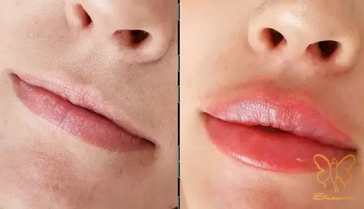 تزریق ژل لب مشهد