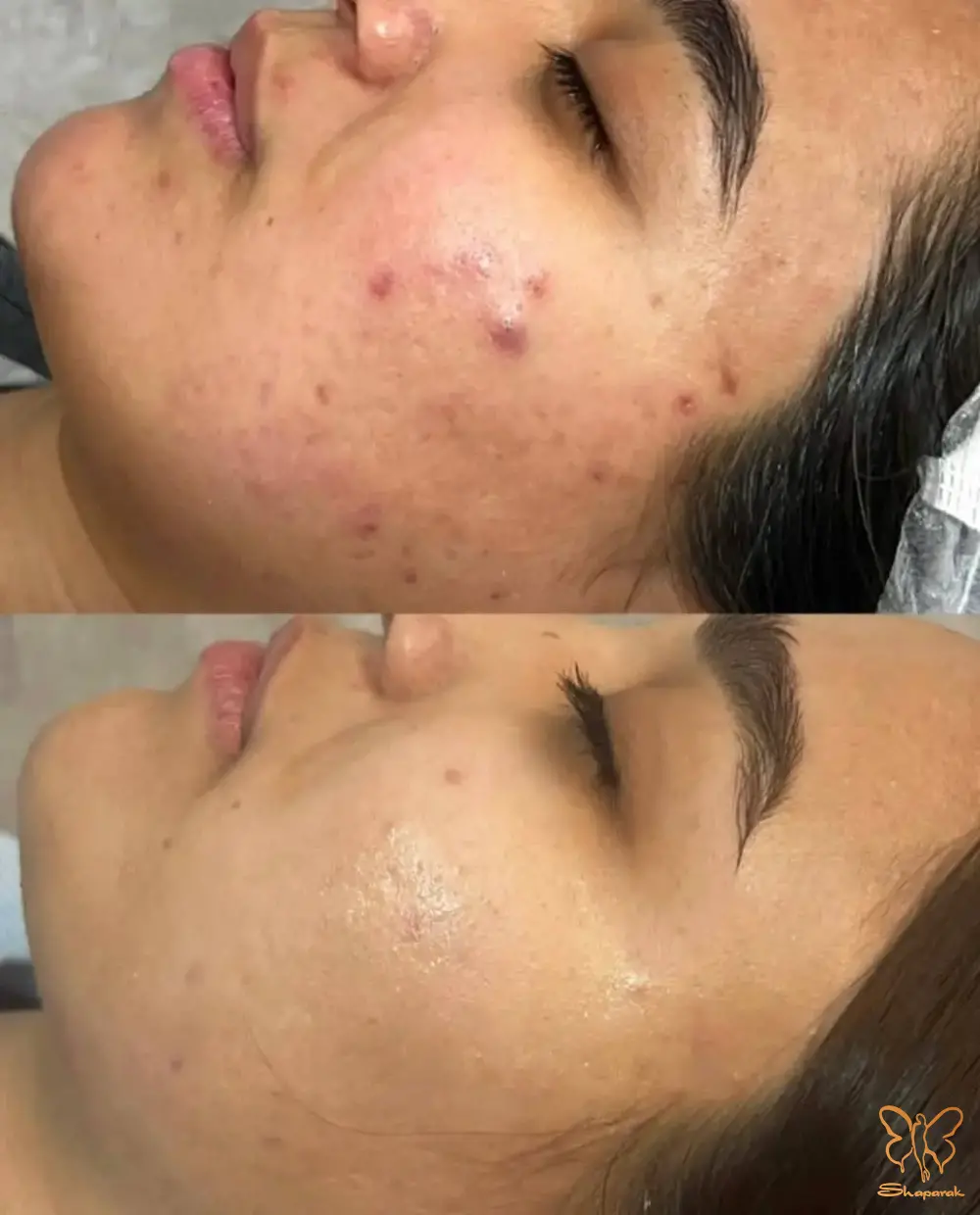 فیشیال های تخصصی پوست مشهد