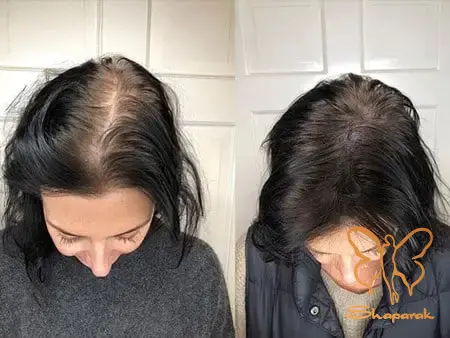 کاشت مو در مشهد کاشت مو در مشهد