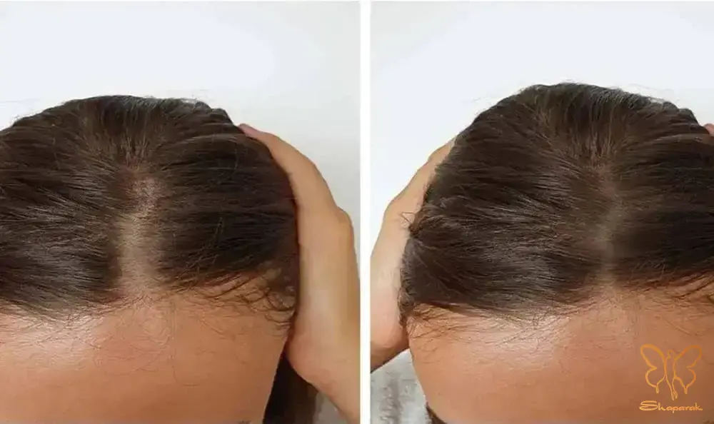 دستورالعمل های پس از مزوتراپی برای نتیجه گیری بهتر در مشهد دستورالعمل های پس از مزوتراپی برای نتیجه گیری بهتر در مشهد