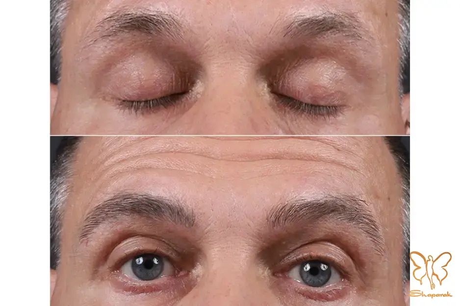 آلوپسی کششی آلوپسی کششی