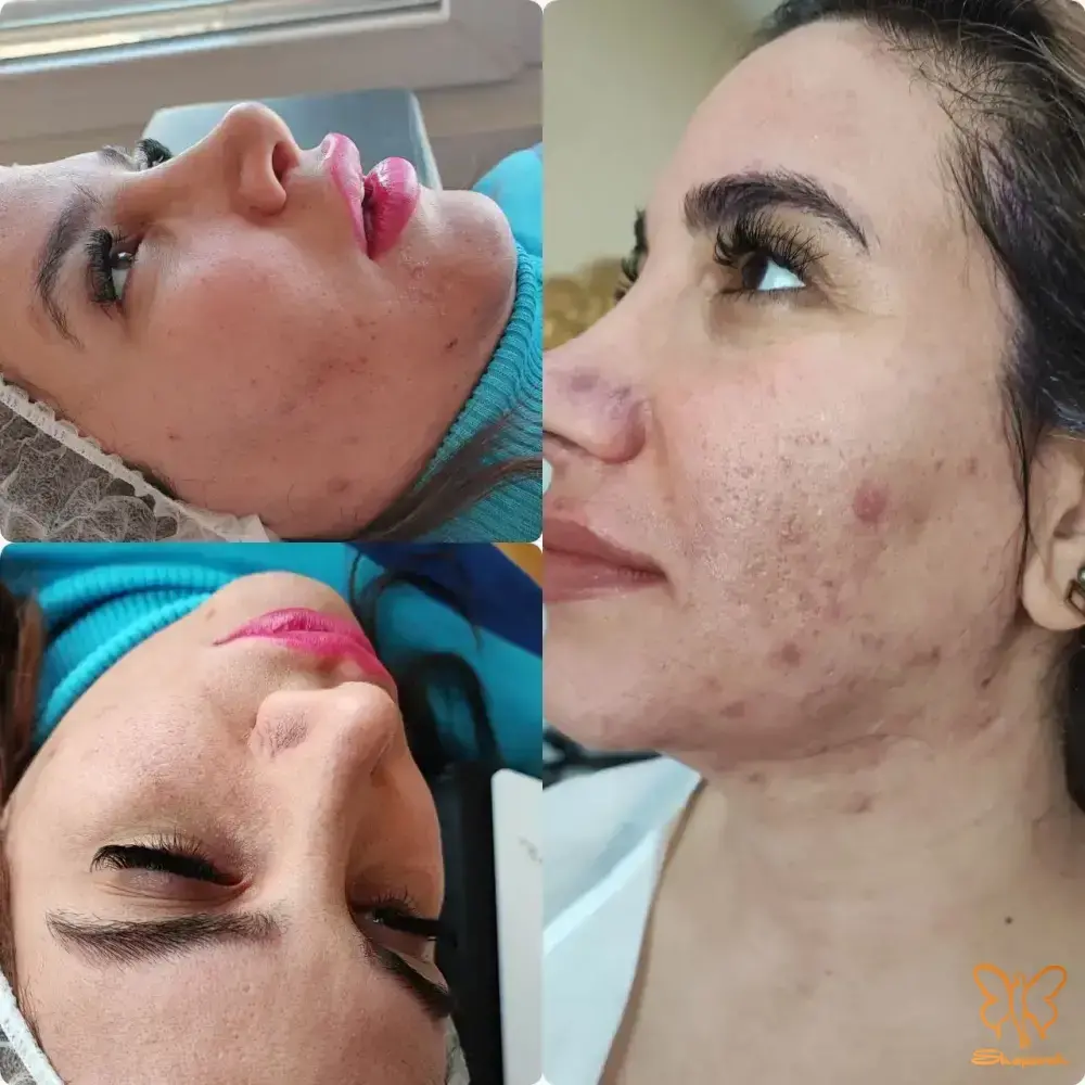پاکسازی های تخصصی مشهد معجزه داشتن پوستی با کیفیت