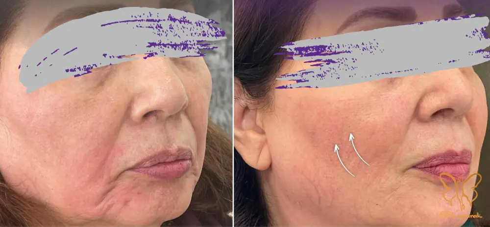 کلینیک تخصصی پوست و مو شاپرک طلایی مشهد