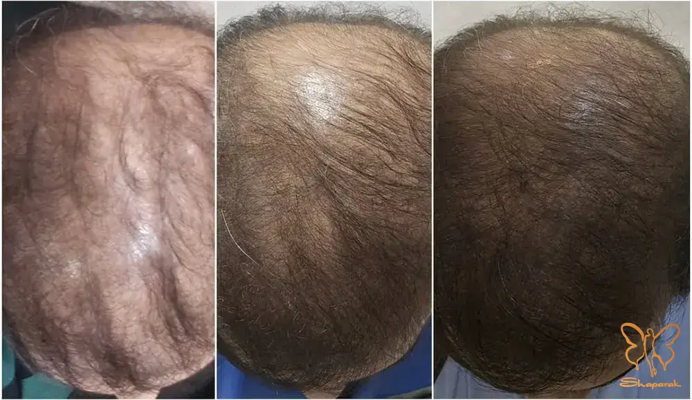 هیرفیلر الپاژینا سر مشهد