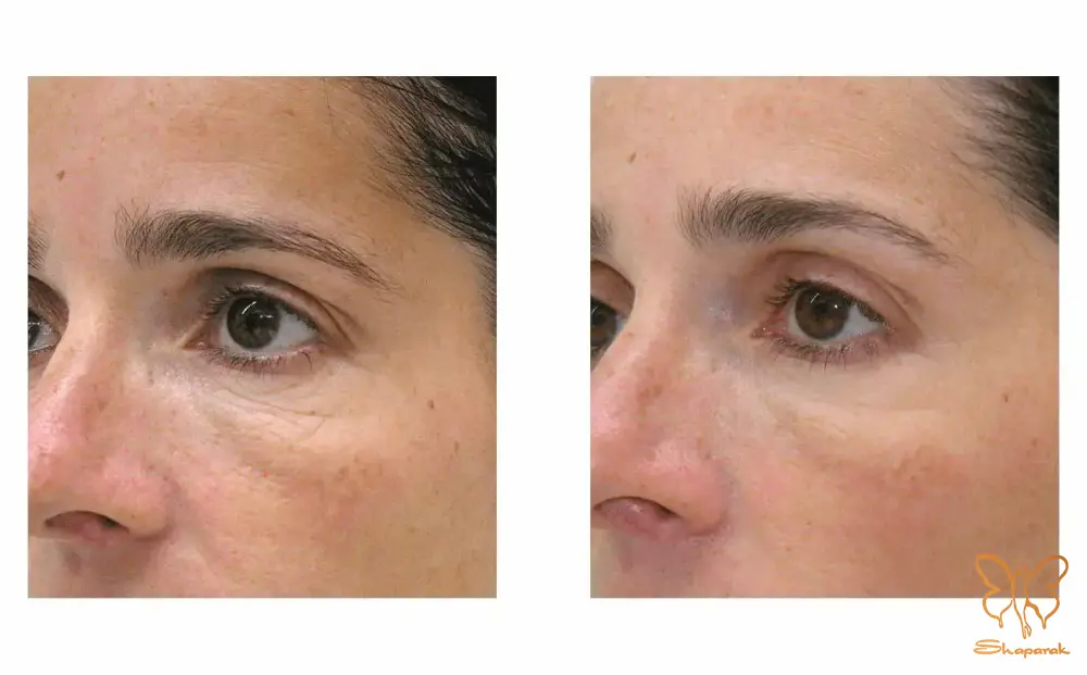 کلینیک تخصصی پوست و مو شاپرک طلایی مشهد کلینیک تخصصی پوست و مو شاپرک طلایی مشهد