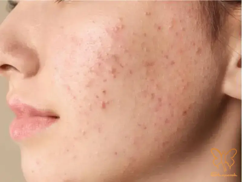 تفاوت کلیدی فولیکولیت مالاسزیا با آکنه ولگاریس تفاوت کلیدی فولیکولیت مالاسزیا با آکنه ولگاریس